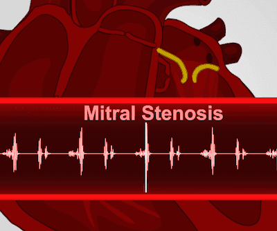 Cardiac Exam III: Abnormal Heart Sounds and Levine Scale