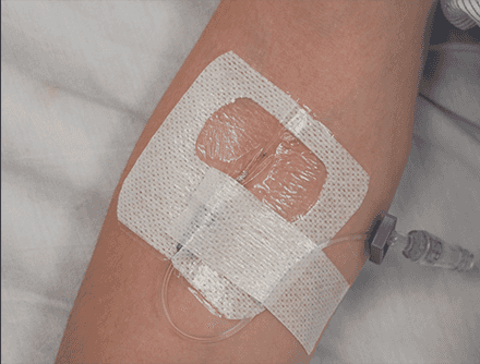Peripheral Venous Cannulation and Catheter Insertion