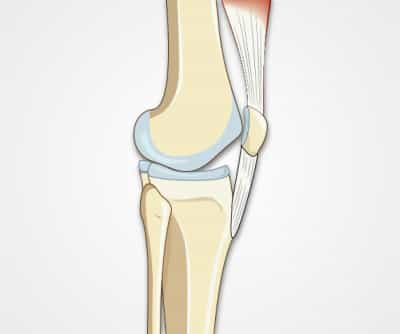 Knee Exam: Ligament, Meniscal and Patella Tests