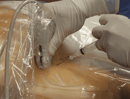 Catheter Insertion in Femoral Vein: FV CVC Placement