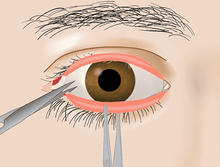 Extraocular Eye: Lateral Canthotomy and Inferior Cantholysis