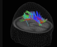 Diffusion Tensor Imaging in Traumatic Brain Injury