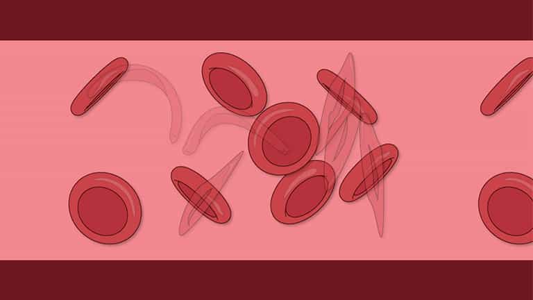 Sickle Cell Anemia: Multiple Alleles, Incomplete Dominance and Co-dominance