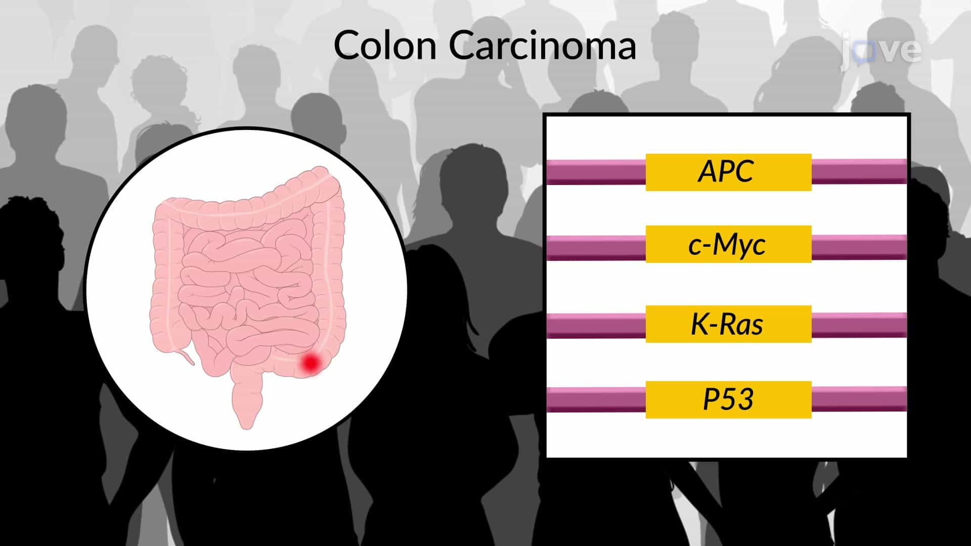 Cancer, Somatic Mutations and Multi-Hit Theory