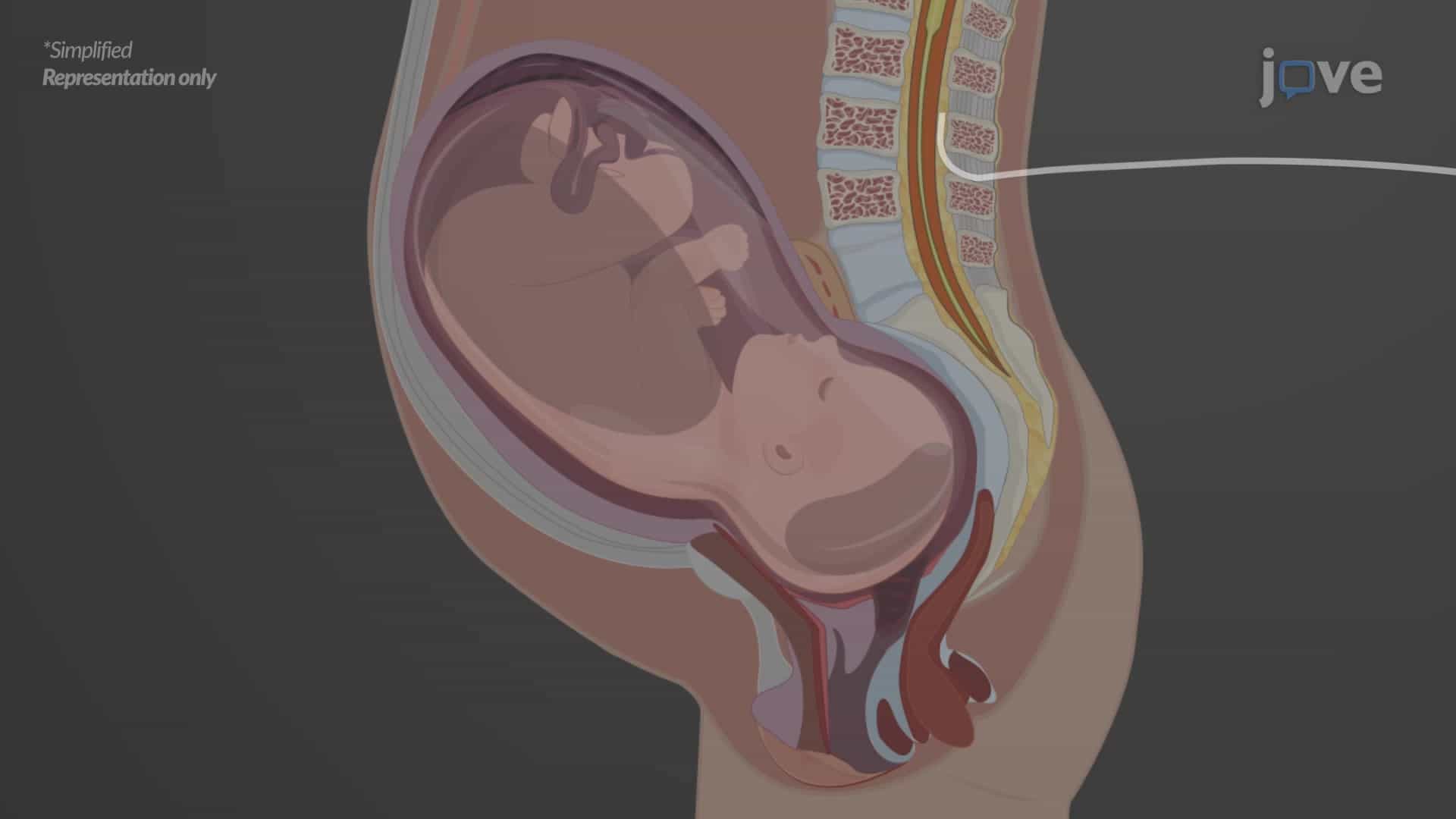 Local Anesthetics: Clinical Application as Epidural Anesthesia