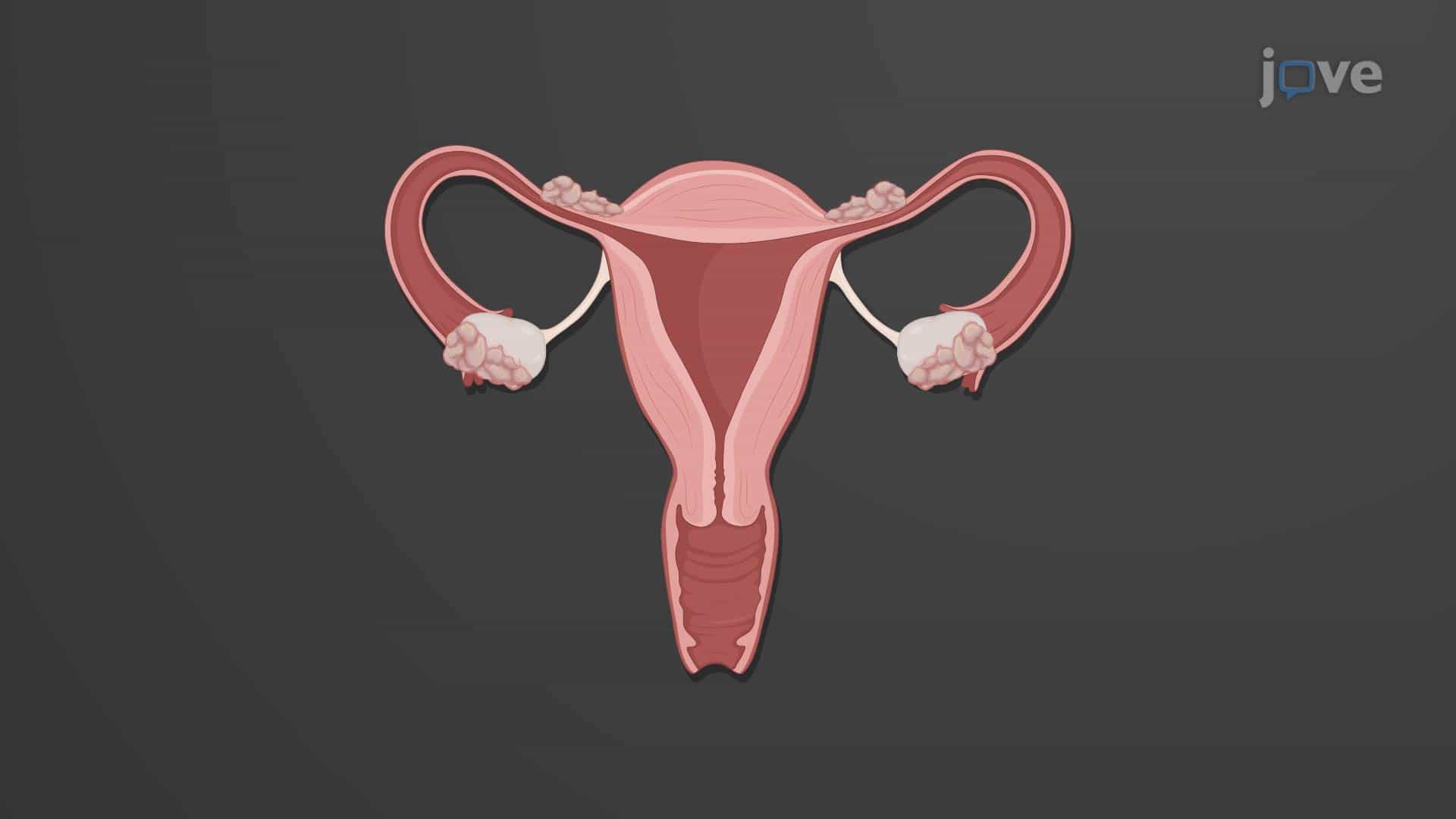 Infertility in Females