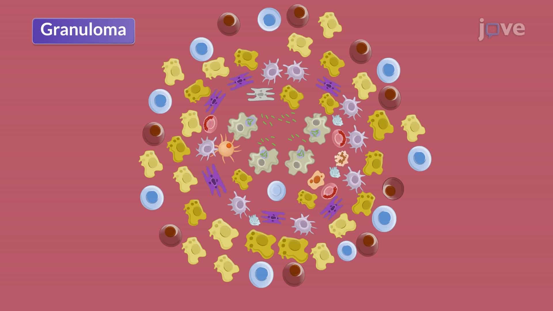 Pulmonary Tuberculosis II