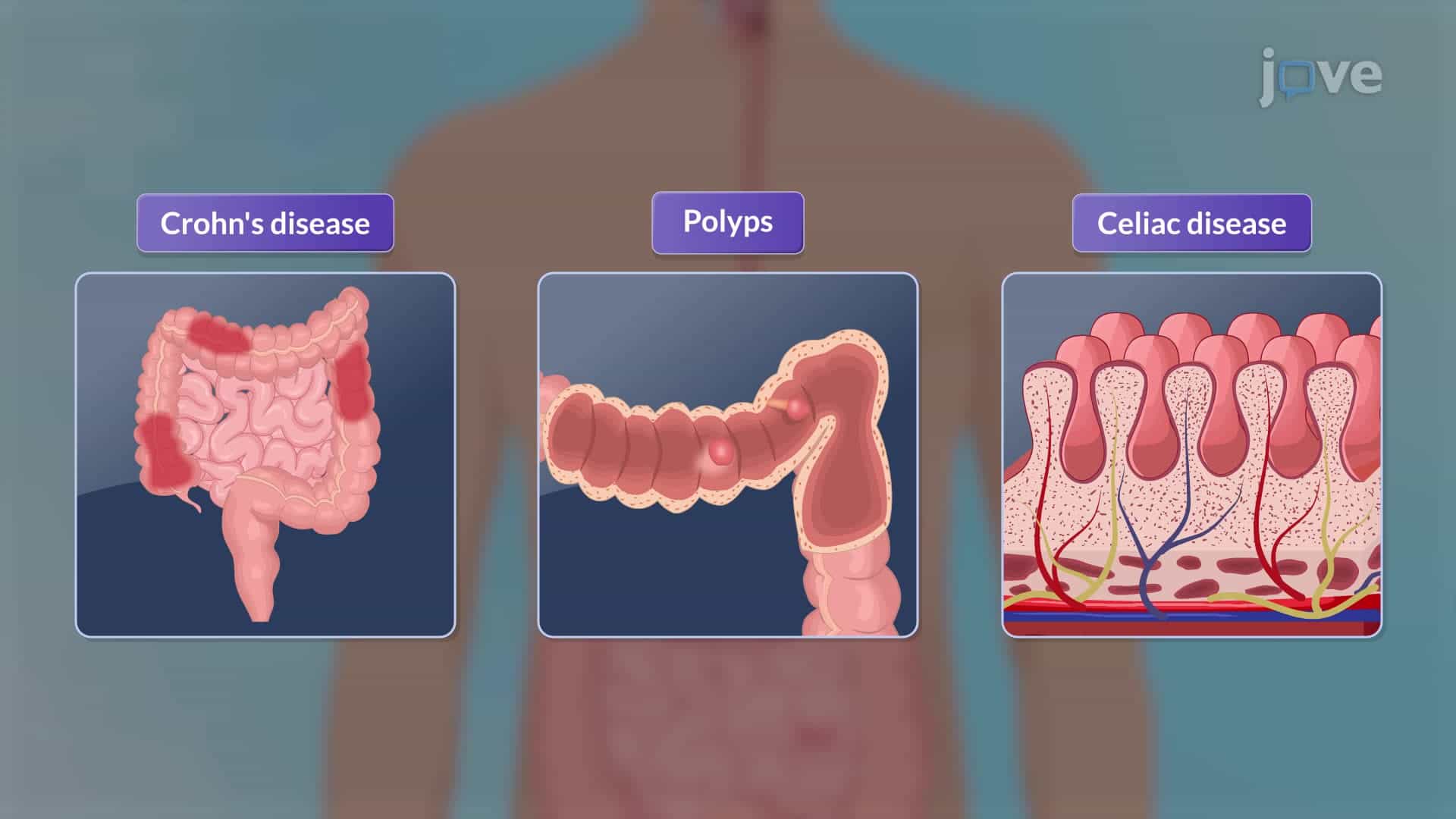 Endoscopic Procedures III: Video Capsule Endoscopy