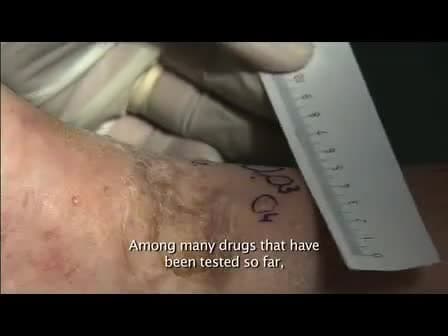 Electrochemotherapy of Tumours