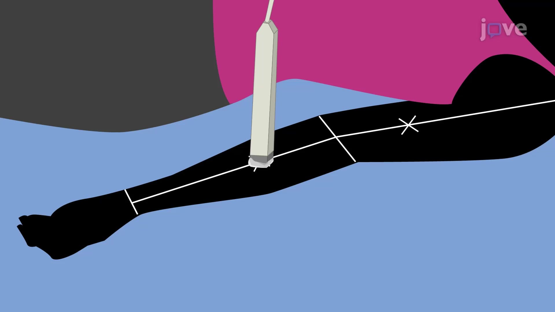 Lymphedema Ultrasonography: A Technique to Measure the Change in Thickness of an Affected Tissue
