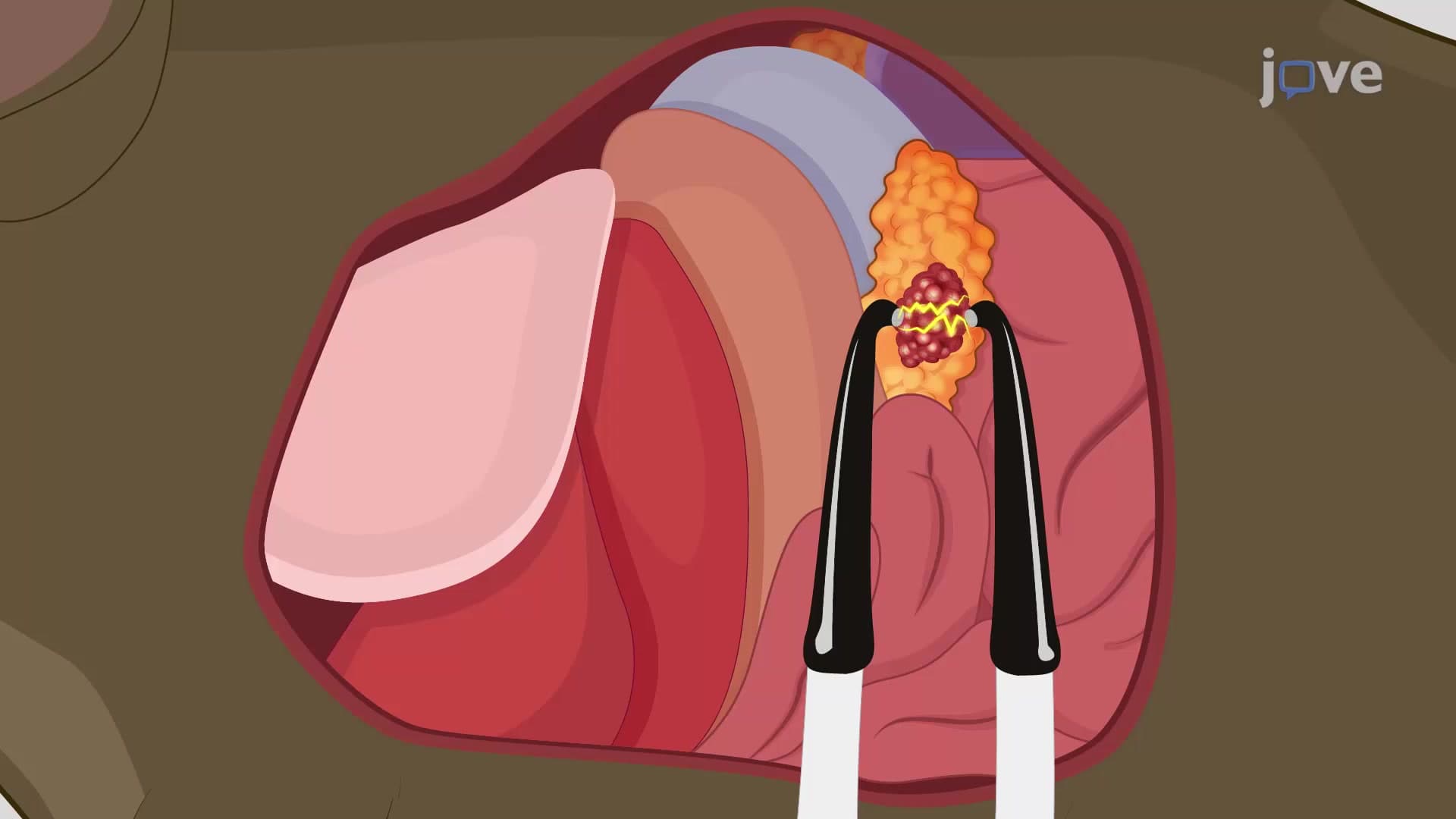 Irreversible Electroporation: A Technique for Ablating Pancreatic Tumor in Mouse