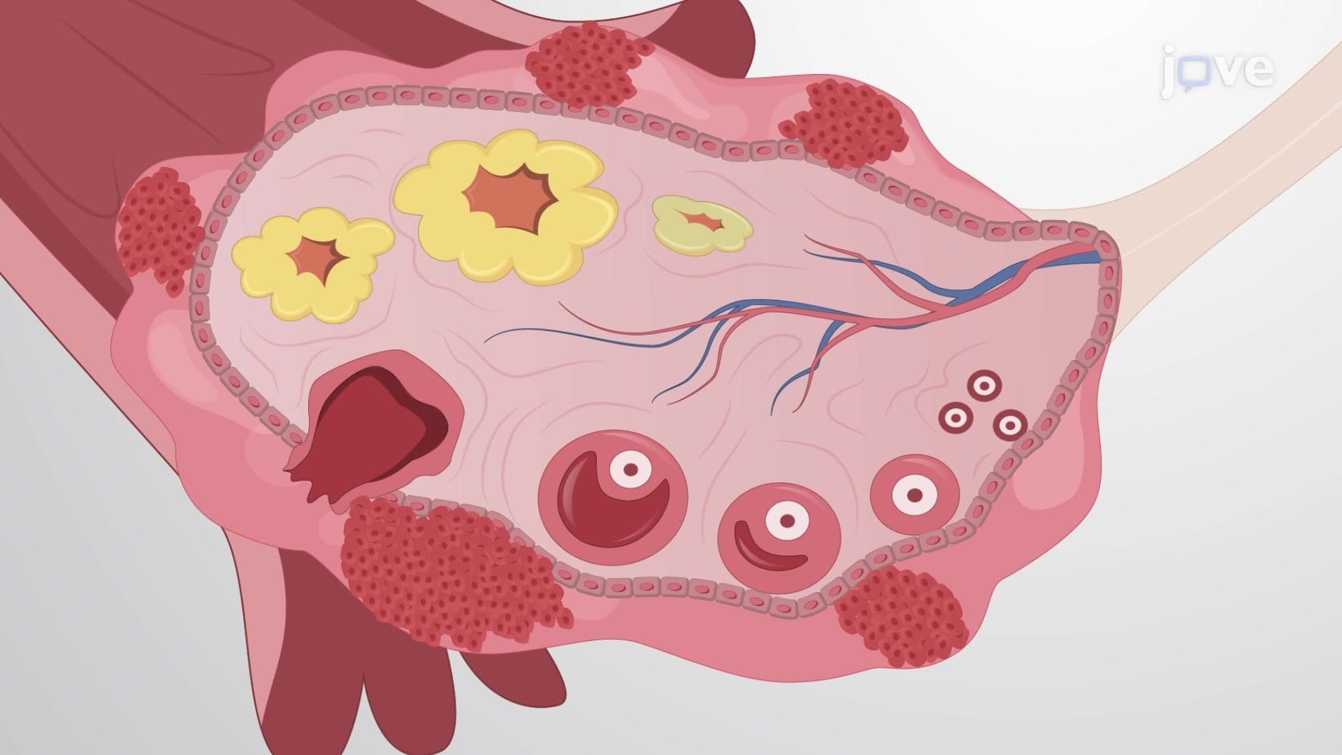 Obtaining Primary Ovarian Cancer Cells from Solid Specimens: A Method to Culture Epithelial Ovarian Cancer Cells from Ovarian Tumor Specimens