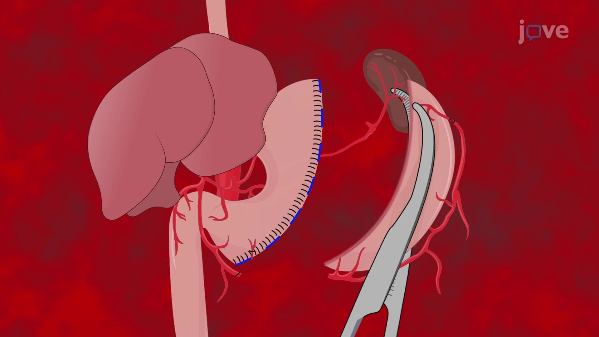 Murine Vertical Sleeve Gastrectomy: A Surgical Procedure to Downsize Stomach in Experimental Mouse Models