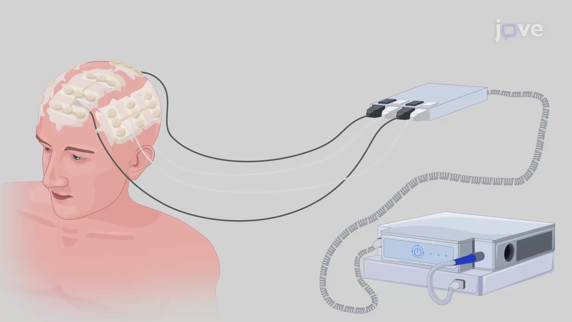 Tumor Treating Fields Application in Human Brain Tumor Models: A Non-invasive Technique to Deliver Alternating Electric Fields to Human Brain for Treating Brain Tumor