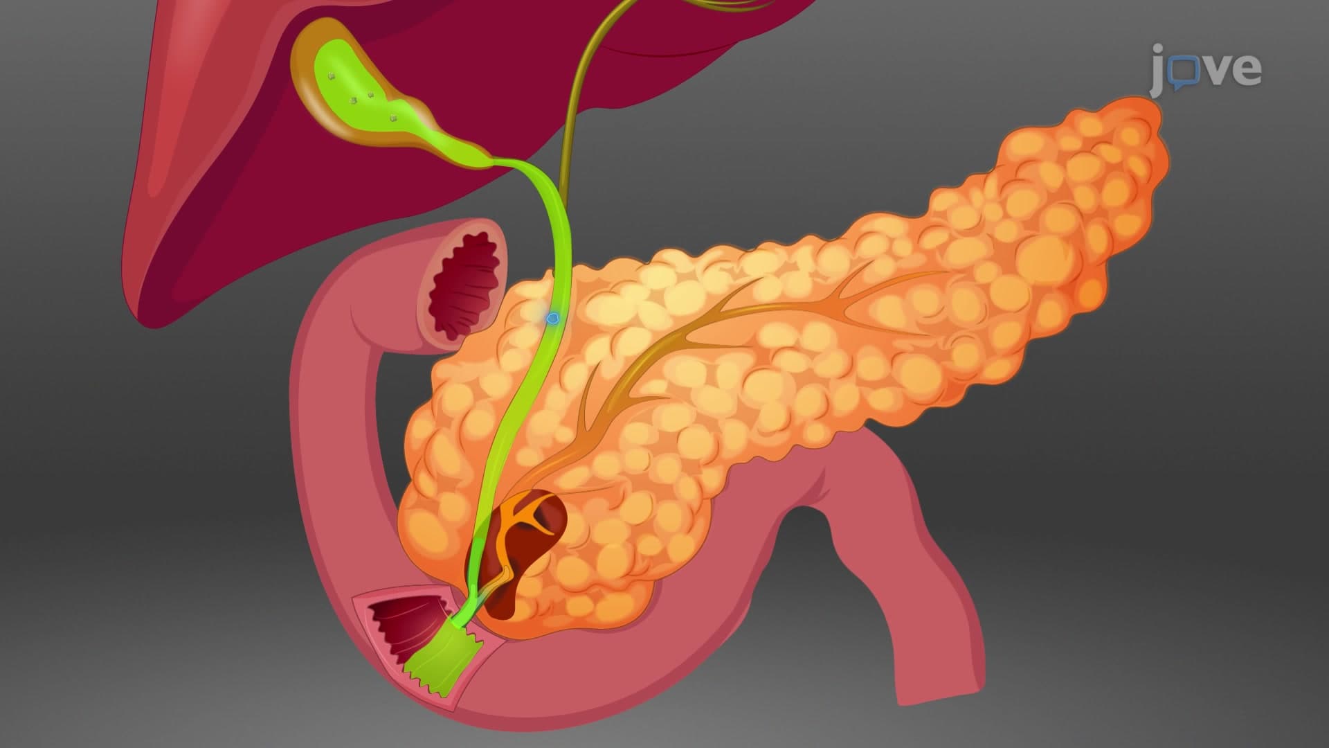 Acute Biliary Pancreatitis Model: A Method to Generate Acute Biliary Pancreatitis Mouse Model via Pancreatic Duct Infusion