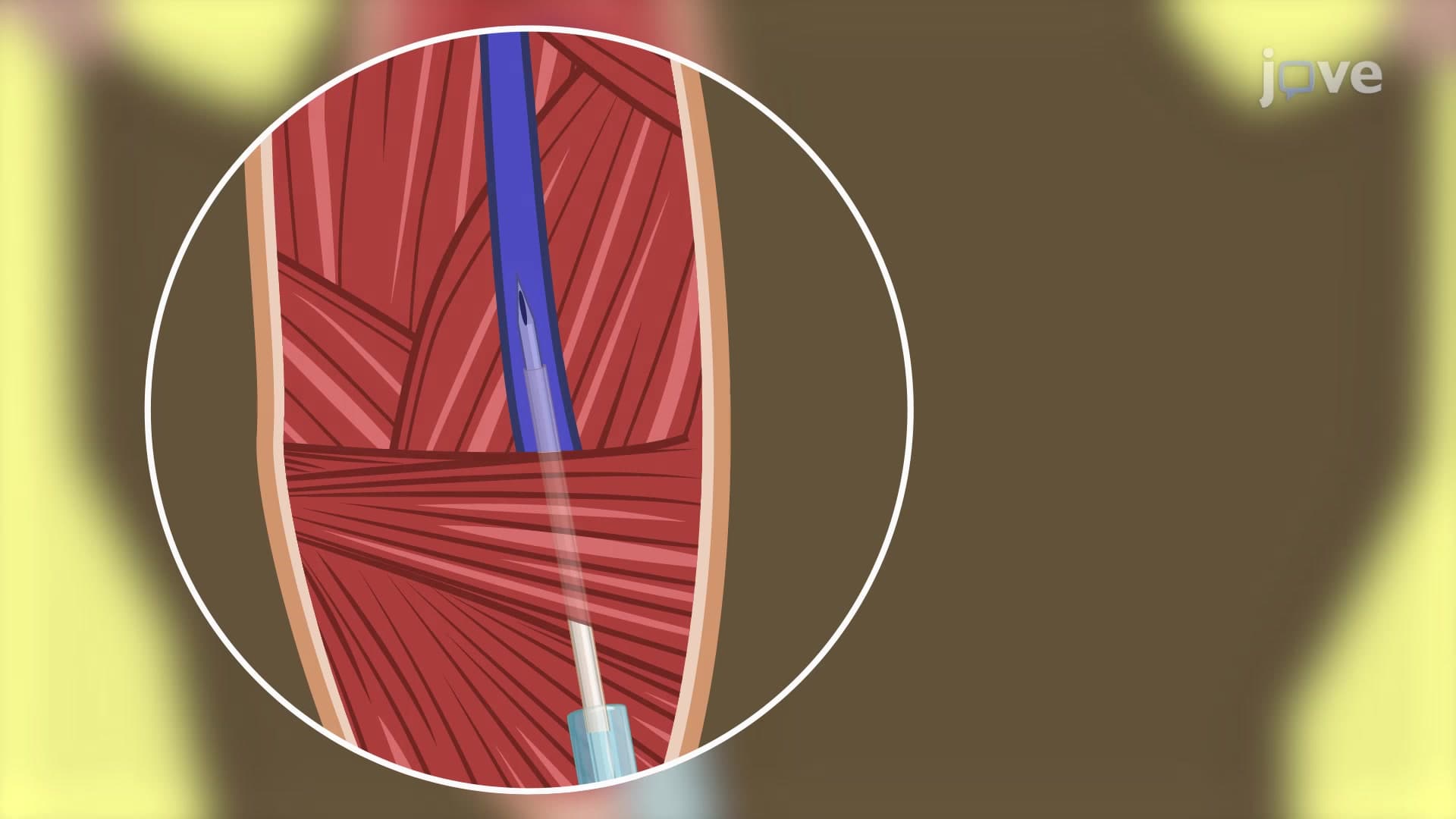 Catheter Based Intravenous Injection of Experimental Agents: A Technique for Delivering Experimental Agents Intravenously Through Jugular Vein in Mouse Model
