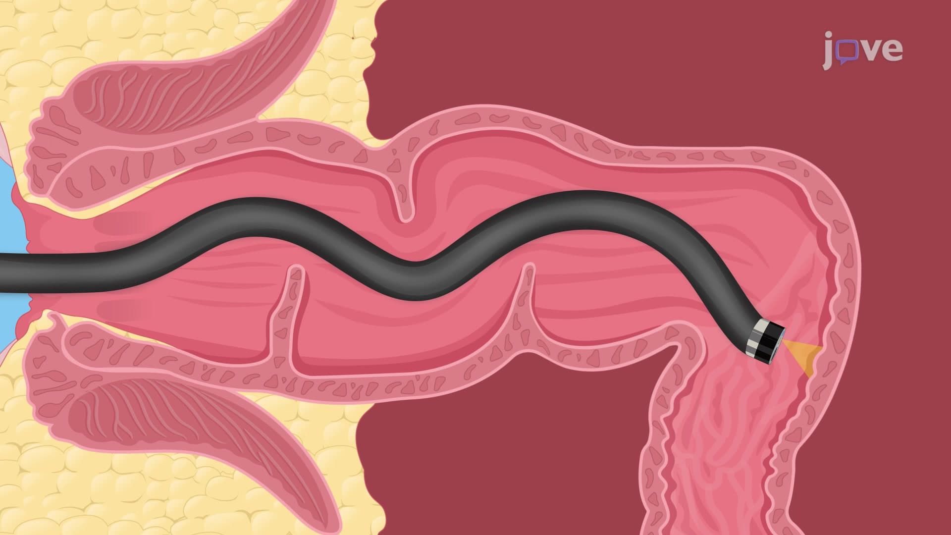 Colonoscopic Guided Pinch Biopsy in a Mouse Model: A Technique to Visualize and Extract Tissue Samples from Mouse Colon