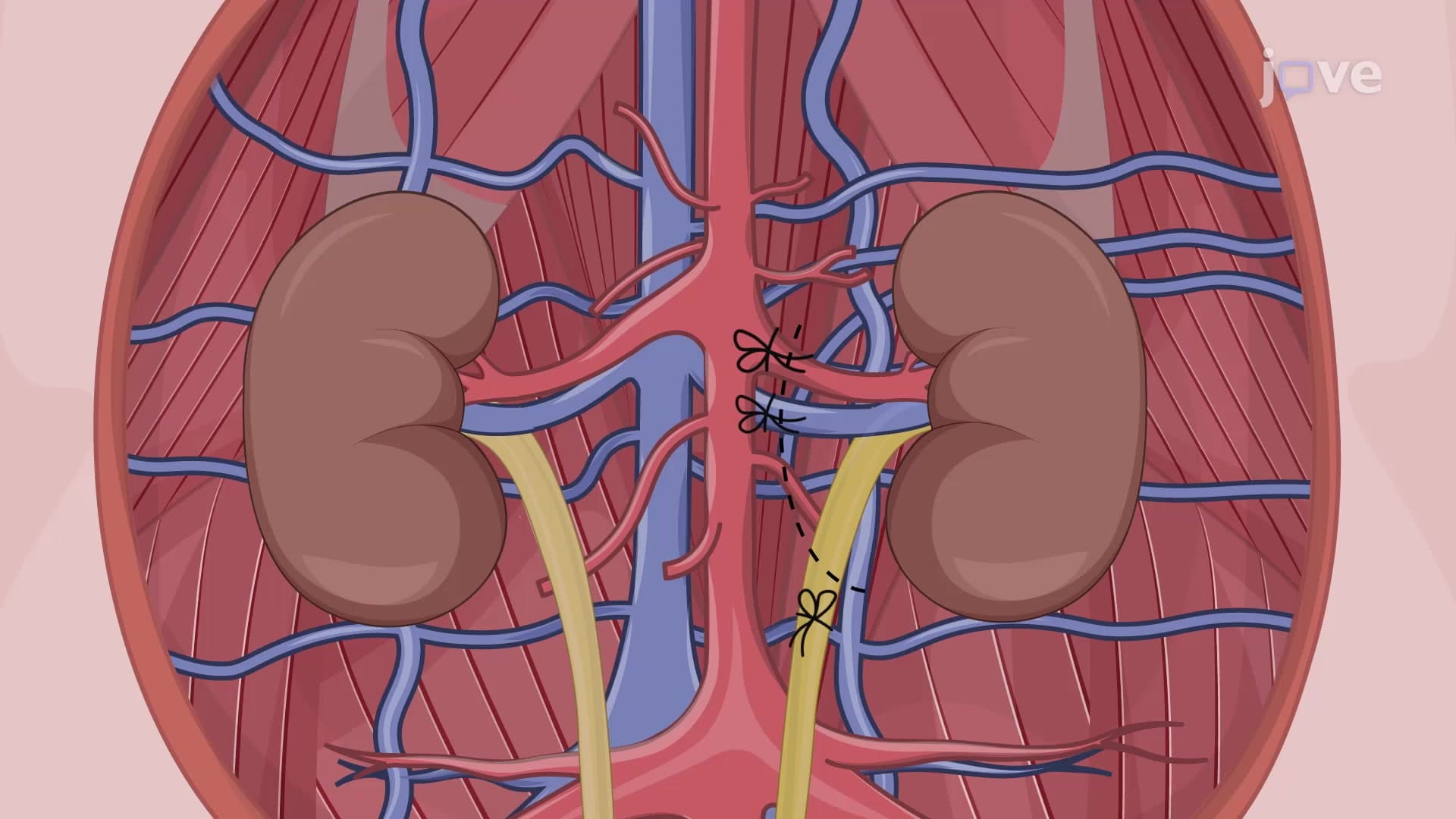 Nephrectomy in a Porcine Model: A Surgical Procedure to Retrieve Porcine Kidney Graft for Transplantation