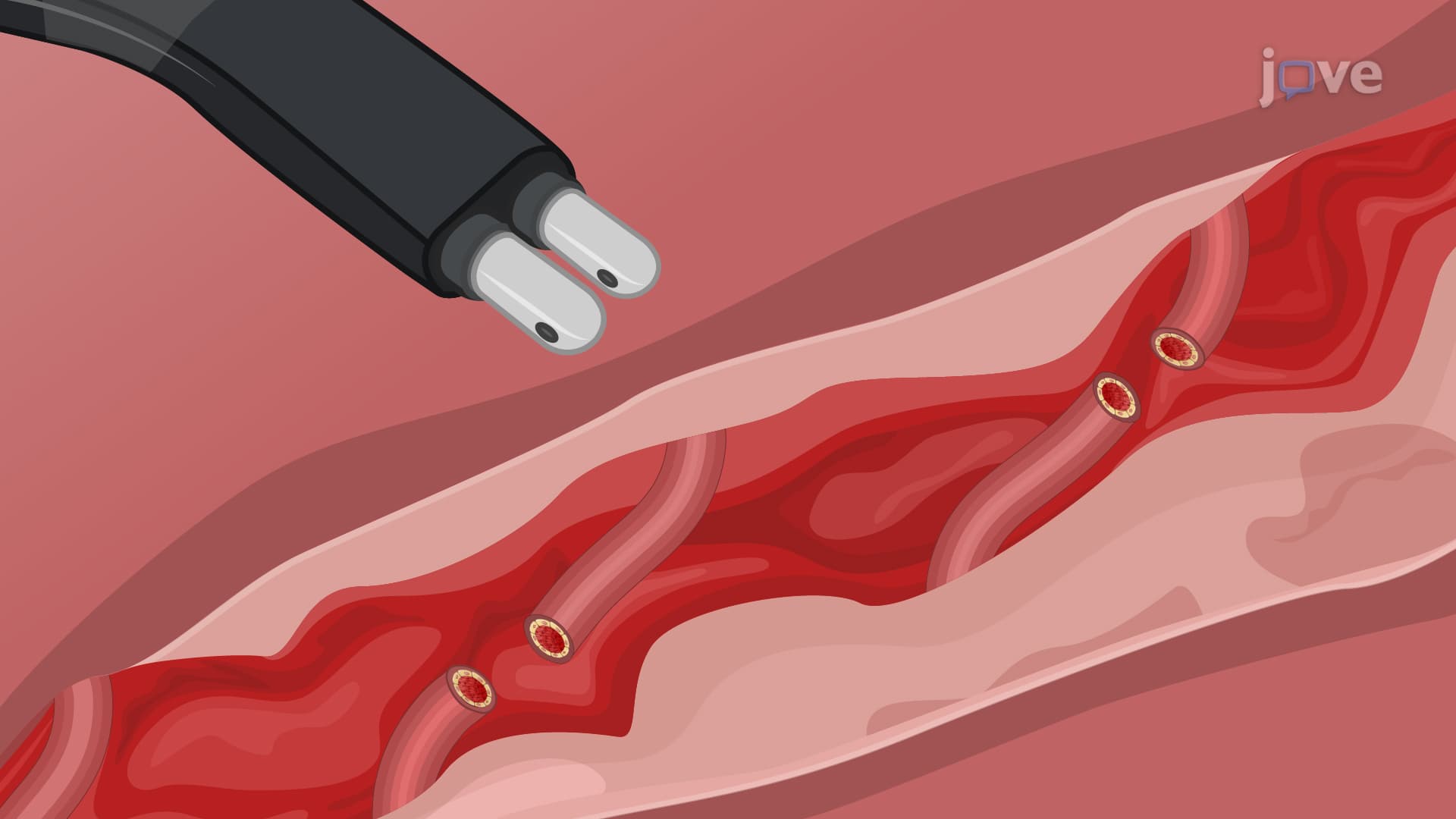 Bipolar Radiofrequency-Based Hemorrhage Arrest in Solid Organ Injury: A Technique to Arrest Bleeding in Porcine Model With Liver Injury Using Electrosurgery