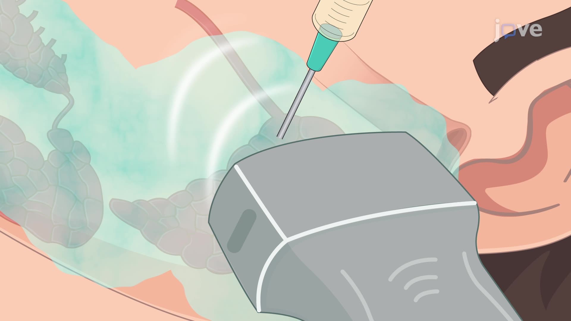 An Ultrasound-Guided Injection of Therapeutic Drugs into Human Salivary Glands