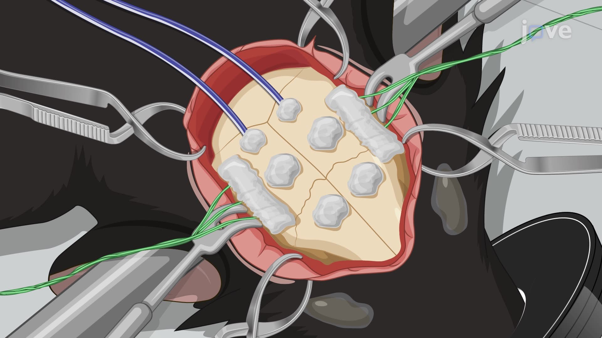 Implanting an On-Head Electrode System in a Rat Model for Real-Time Seizure Detection