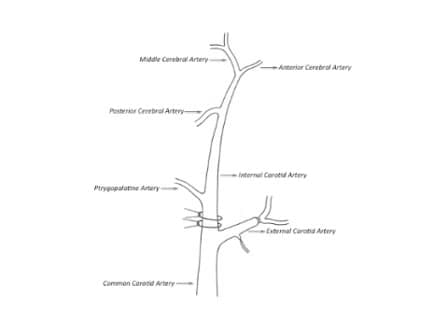 Intraluminal Middle Cerebral Artery Occlusion MCAO Model for Ischemic Stroke with Laser Doppler Flowmetry Guidance in Mice