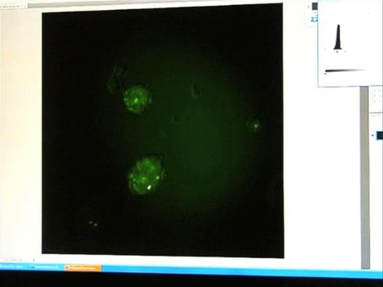 Identification and Isolation of Slow-Dividing Cells in Human Glioblastoma Using Carboxy Fluorescein Succinimidyl Ester (CFSE)