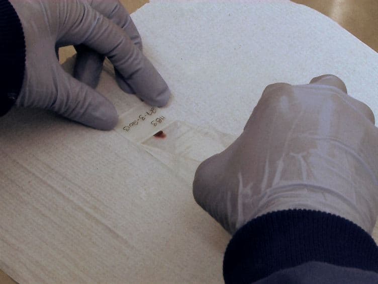 A Simple Protocol for Platelet-mediated Clumping of <em>Plasmodium falciparum</em>-infected Erythrocytes in a Resource Poor Setting