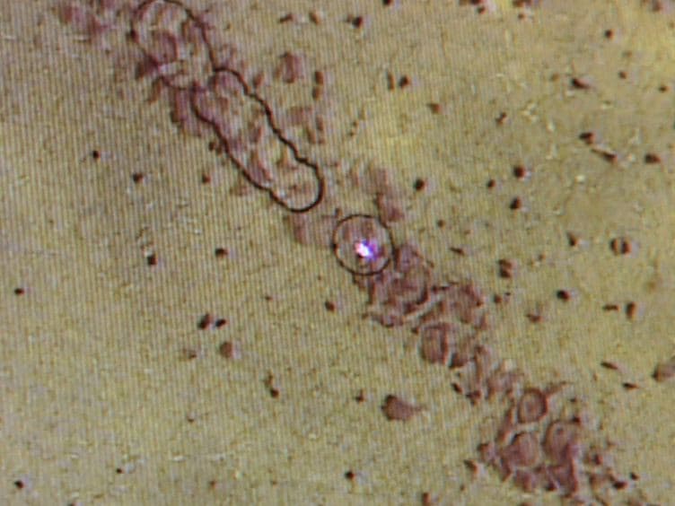 Laser Capture Microdissection of Enriched Populations of Neurons or Single Neurons for Gene Expression Analysis After Traumatic Brain Injury