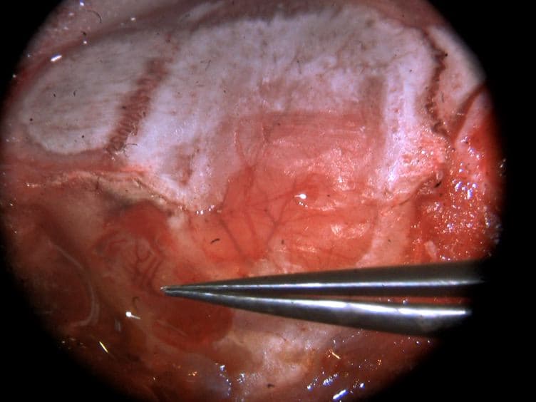 Permanent Cerebral Vessel Occlusion <em>via</em> Double Ligature and Transection