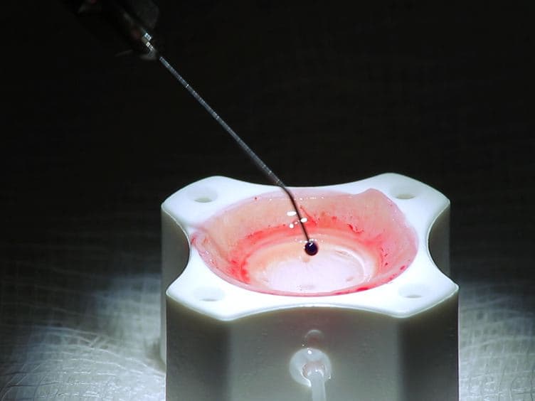 Corneal Donor Tissue Preparation for Descemet's Membrane Endothelial Keratoplasty