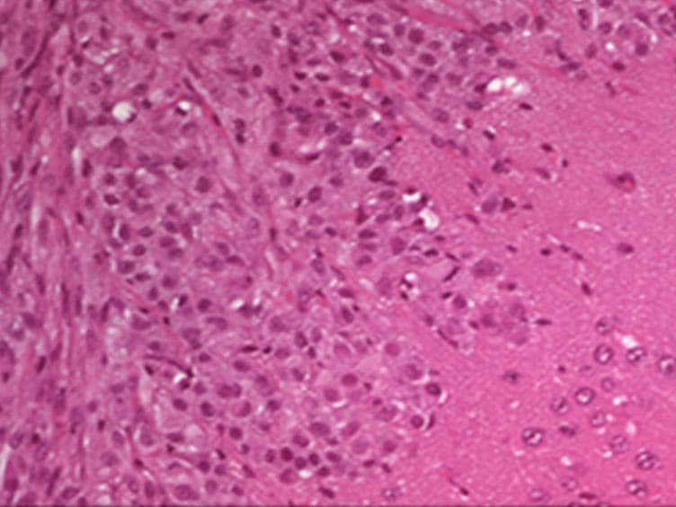 Creating Anatomically Accurate and Reproducible Intracranial Xenografts of Human Brain Tumors