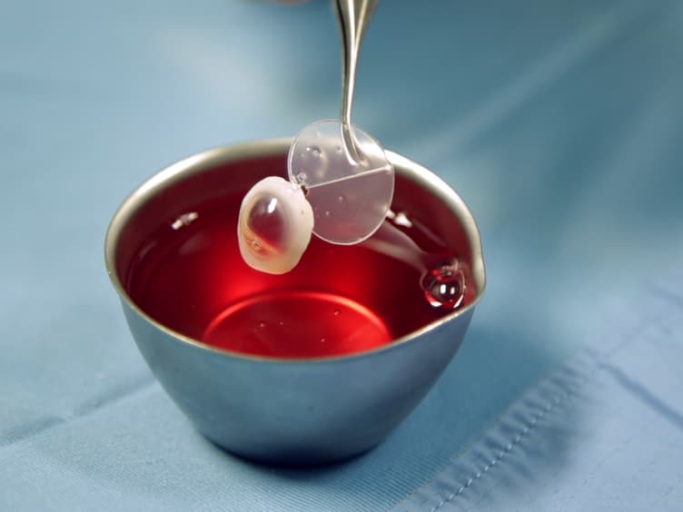 An “All-laser” Endothelial Transplant