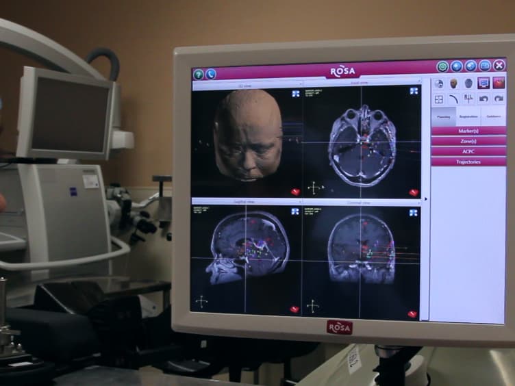 Stereo-Electro-Encephalo-Graphy (SEEG) With Robotic Assistance in the Presurgical Evaluation of Medical Refractory Epilepsy: A Technical Note