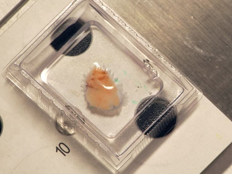 Laser-capture Microdissection of Human Prostatic Epithelium for RNA Analysis