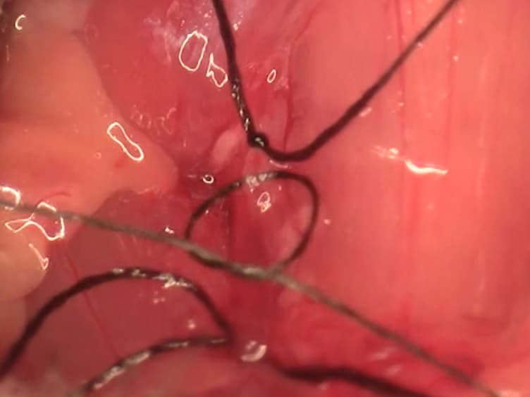 Surgical Approach for Middle Cerebral Artery Occlusion and Reperfusion Induced Stroke in Mice