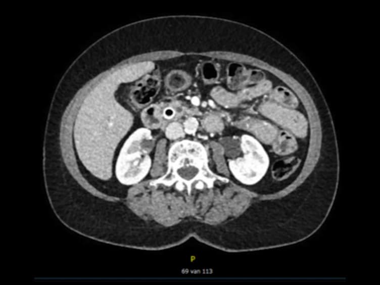 Laparoscopic Pancreatoduodenectomy With Modified Blumgart Pancreaticojejunostomy