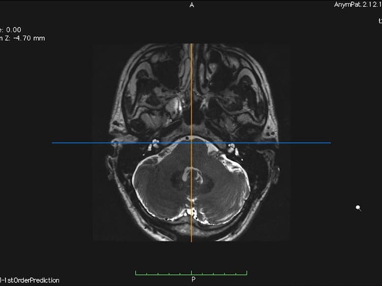 In Vivo Morphometric Analysis of Human Cranial Nerves Using Magnetic Resonance Imaging in Menière's Disease Ears and Normal Hearing Ears