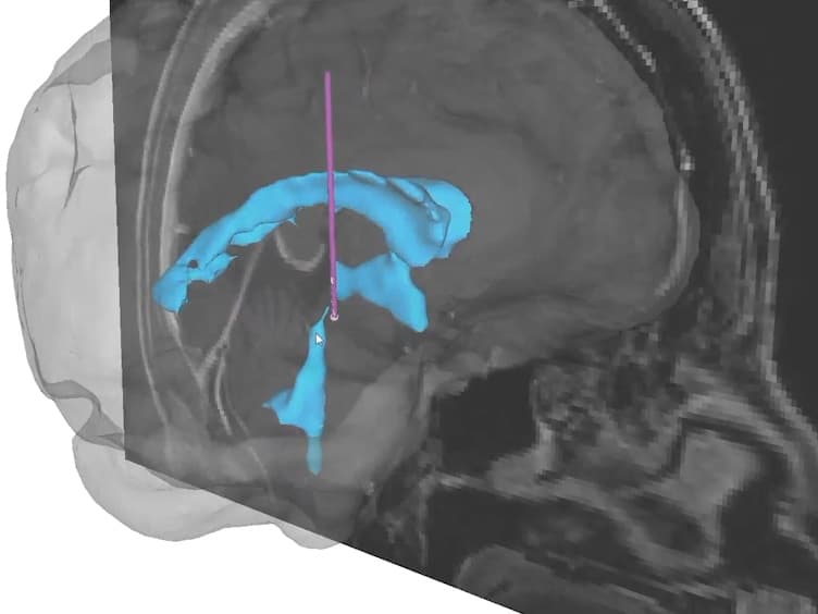 Targeting Neuronal Fiber Tracts for Deep Brain Stimulation Therapy Using Interactive, Patient-Specific Models