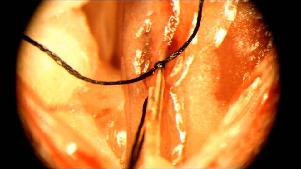 Direct Drug Delivery to Kidney via the Renal Artery