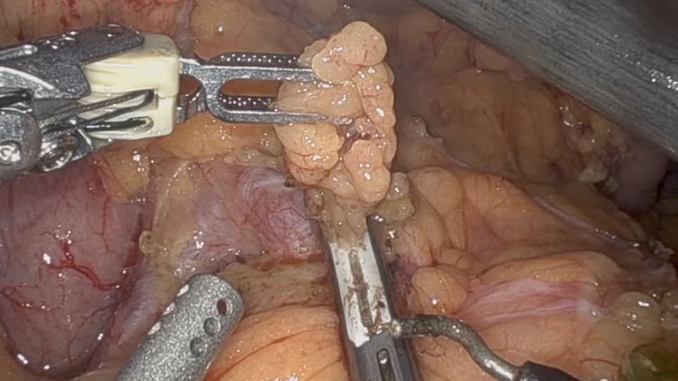 Robot Assisted Distal Pancreatectomy with Celiac Axis Resection DP-CAR for Pancreatic Cancer: Surgical Planning and Technique