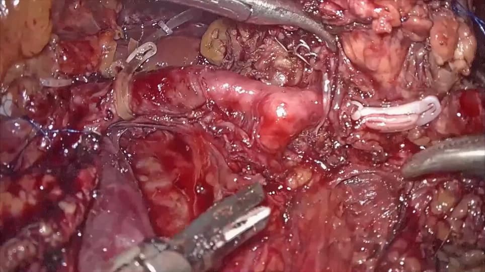 Laparoscopic Radical Antegrade Modular Pancreatosplenectomy via Dorsal-Caudal Artery Approach for Pancreatic Neck-Body Cancer
