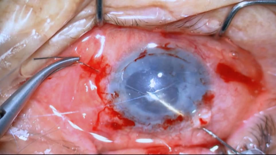 Iris Fixation via External Pentagram Suturing