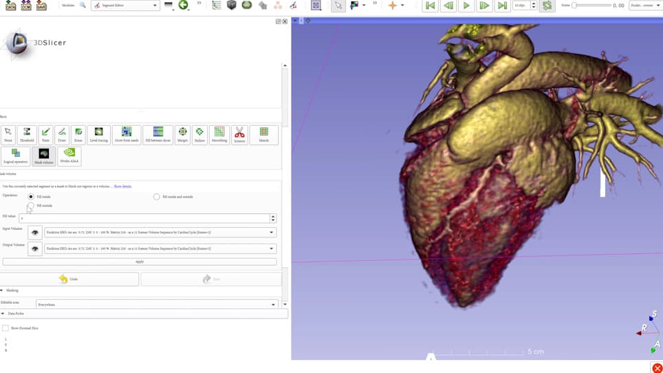Four-Dimensional Computed Tomography-Guided Valve Sizing for Transcatheter Pulmonary Valve Replacement
