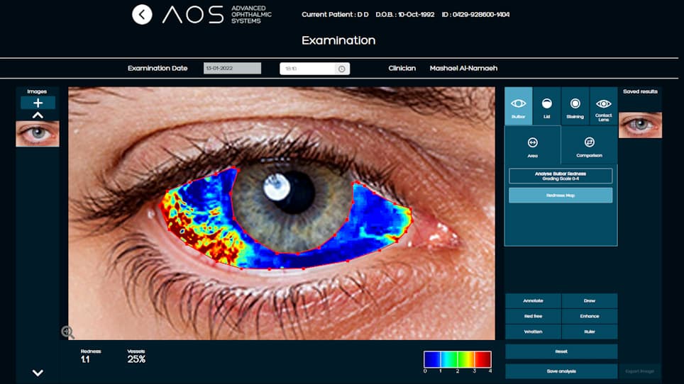 Comparing Objective Conjunctival Hyperemia Grading and the Ocular Surface Disease Index Score in Dry Eye Syndrome During COVID-19