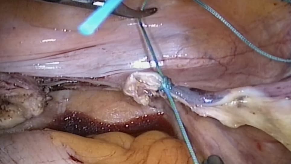 Laparoscopic Non-Mesh Cerclage Pectopexy for Pelvic Organ Prolapse