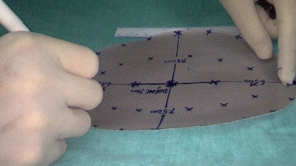 Application of a New Mesh Fixation Method in Laparoscopic Incisional Hernia Repair
