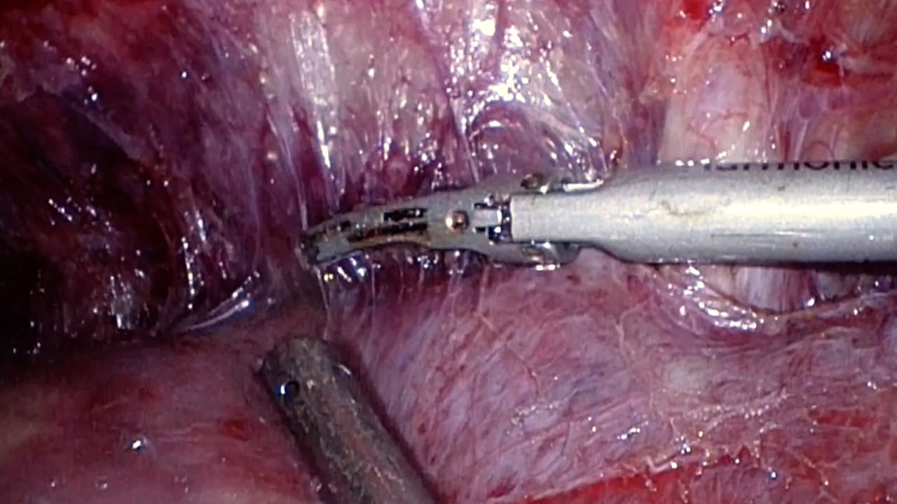 Techniques of Laparoscopic Right Posterior Sectionectomy: Glissonian Approach and a Parenchymal Transection Technique
