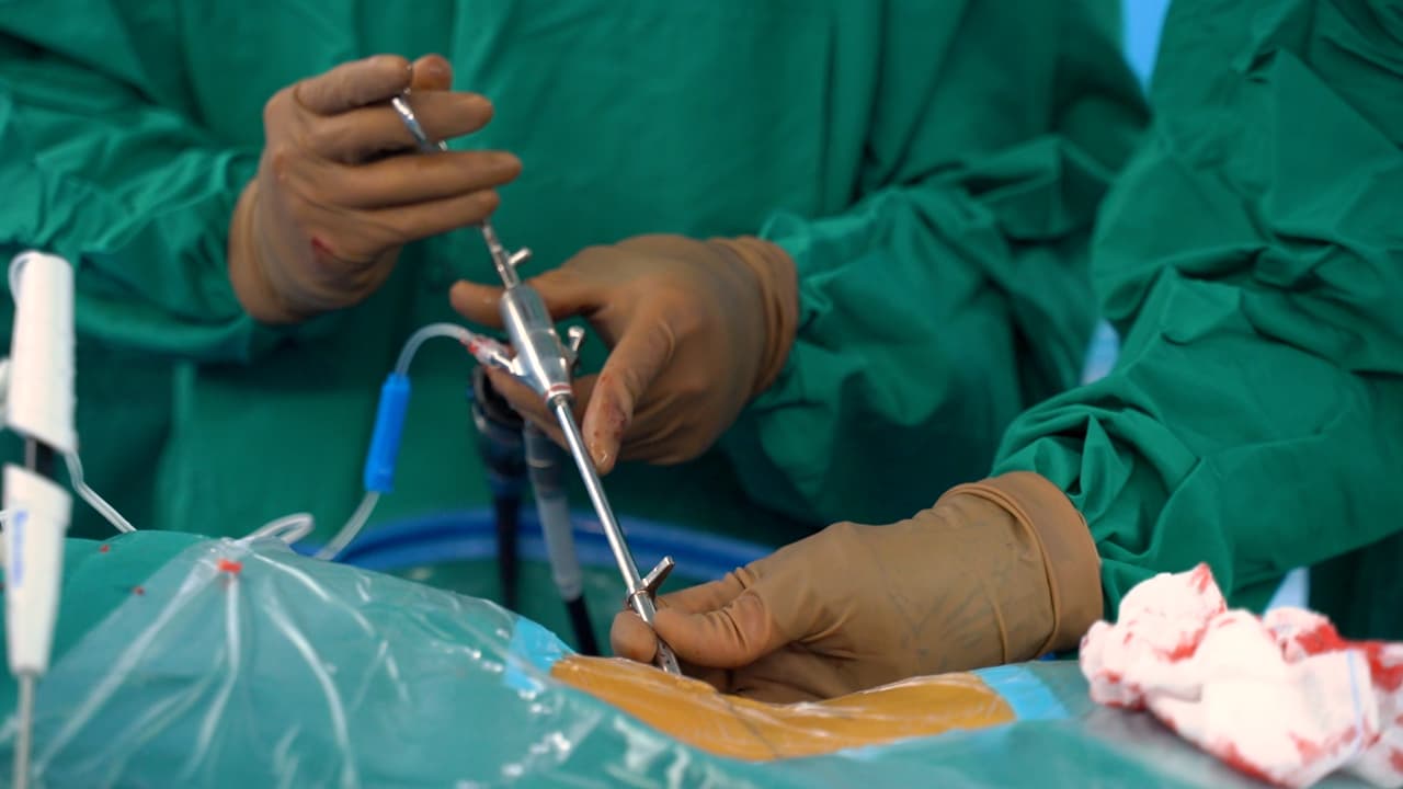 A Suture Technique for Ruptured Annulus Fibrosus Following Decompression Under Percutaneous Transforaminal Endoscopic Discectomy