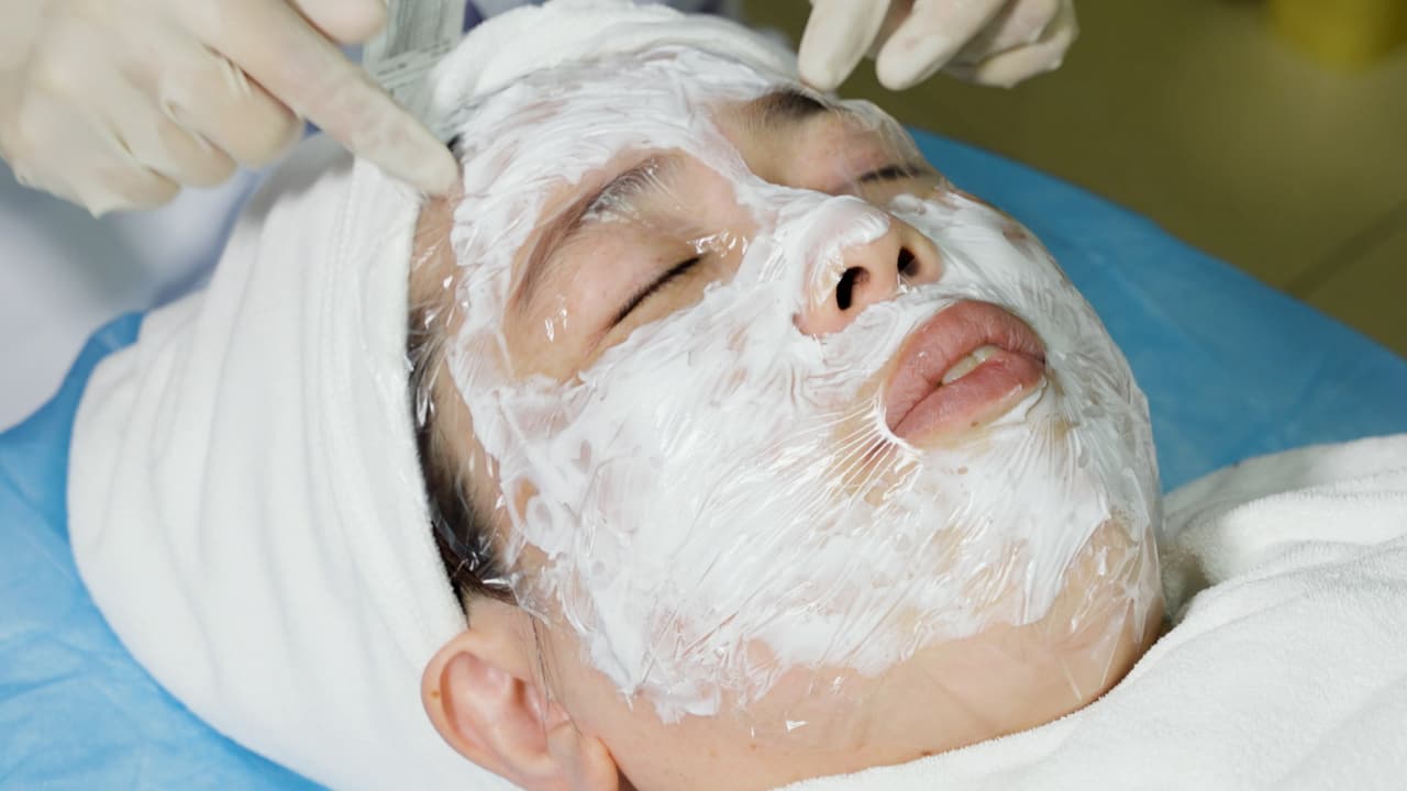 Roller Microneedle Combined with Tranexamic Acid Solution in Treating Melasma